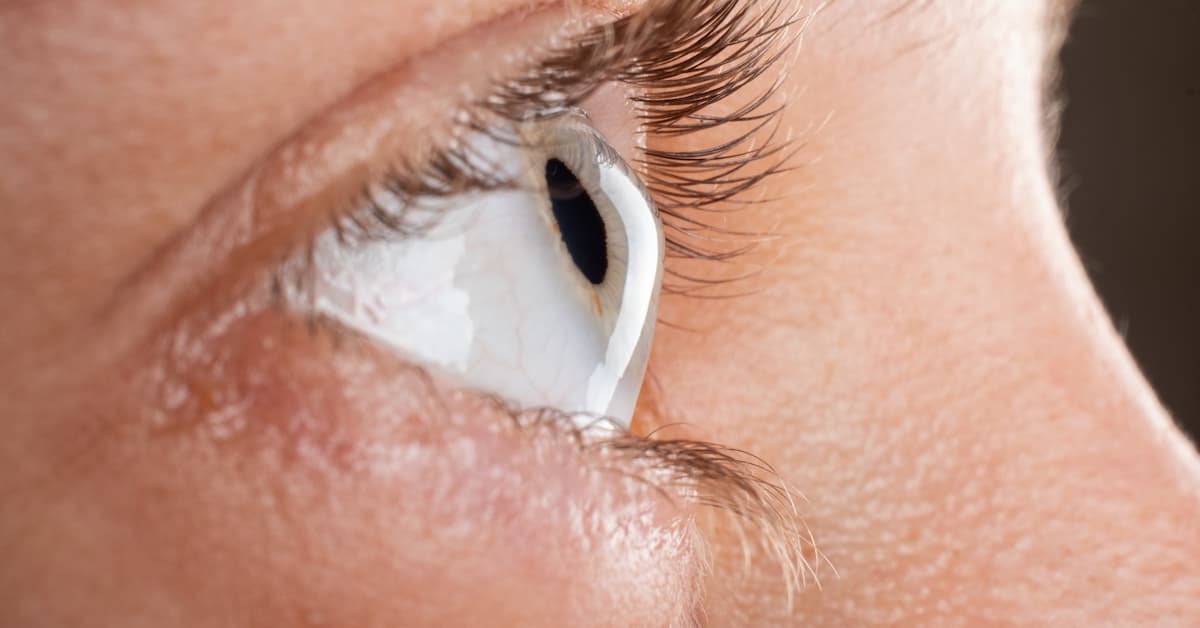 Keratoconus Treatment in Boise keratoconus treatment boise